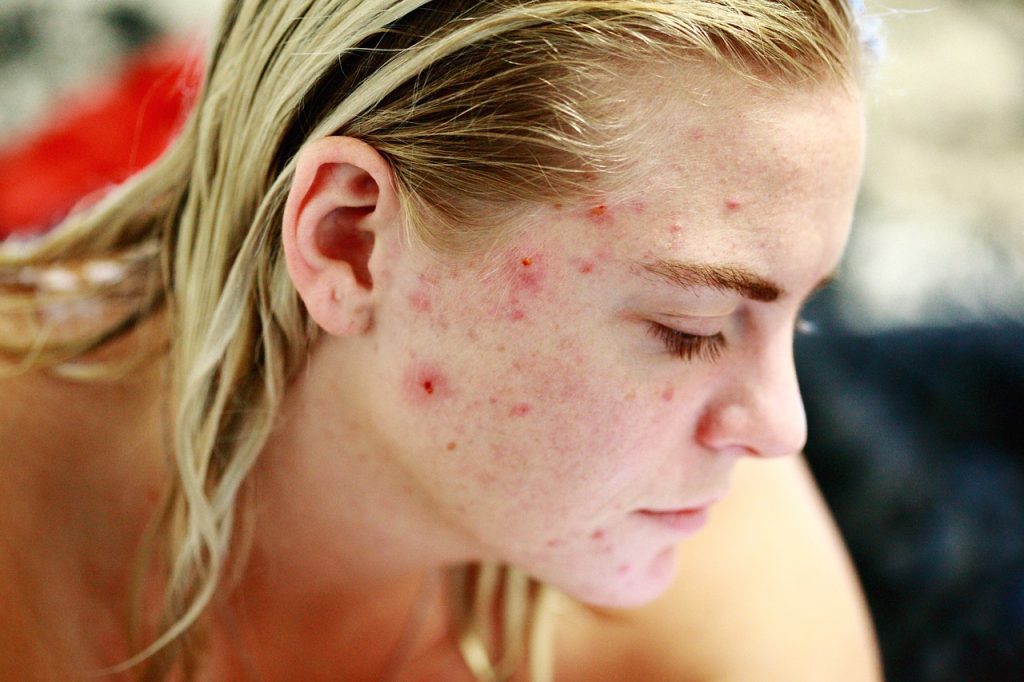 different types of acne