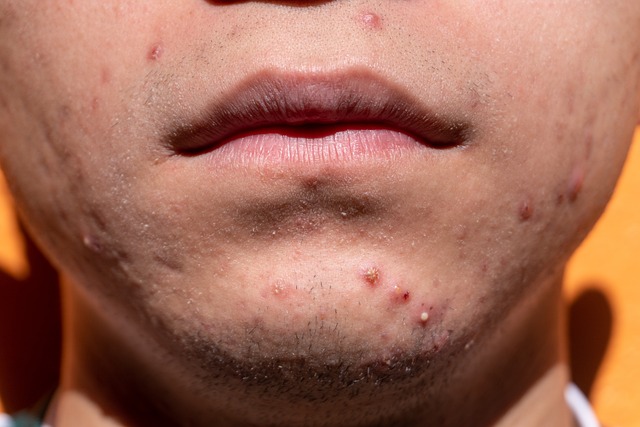 prevent acne scars